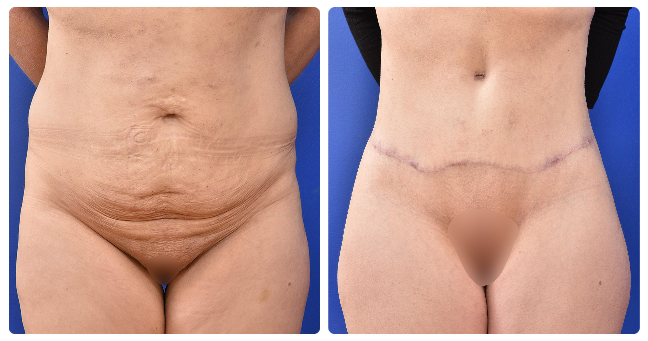 Abdominoplasty - The CAPS Clinic Canberra
